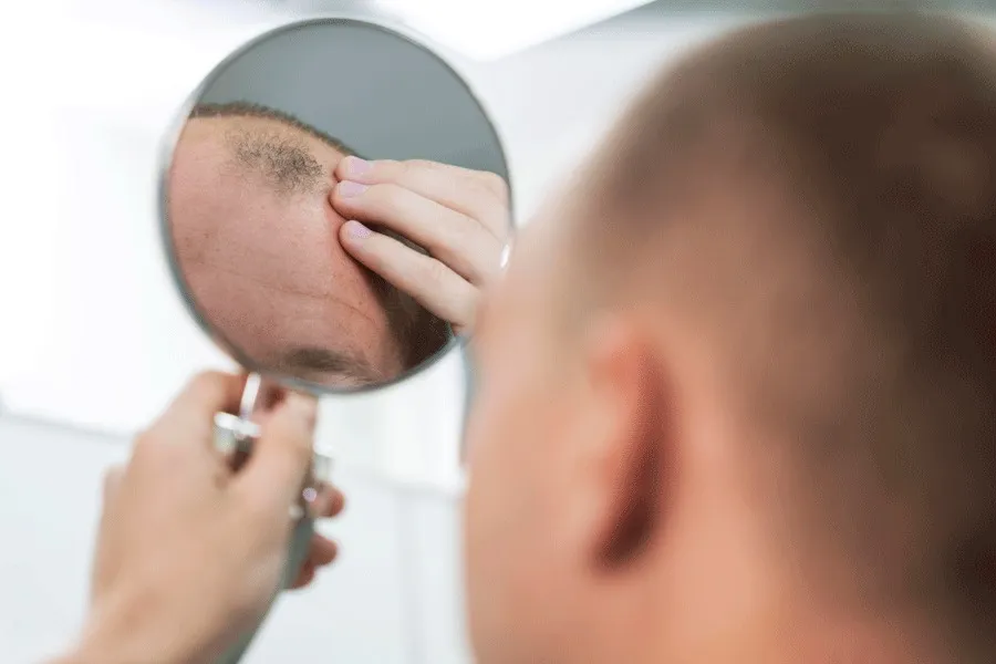 8 Tips om Zwelling na Haartransplantatie te Voorkomen