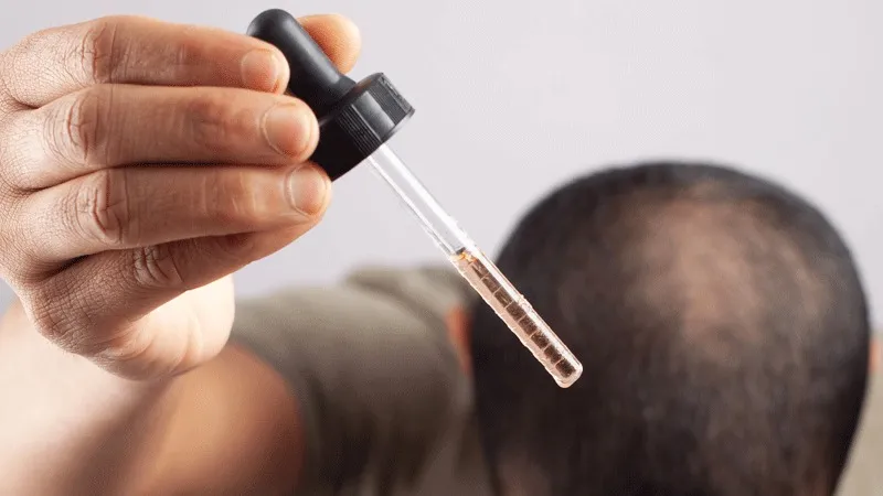 Moet u Minoxidil Nemen na een Haartransplantatie?