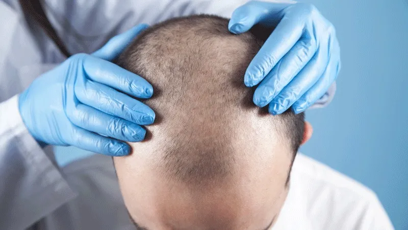 Kan een Volledig Kaal Persoon een Haartransplantatie Ondergaan?