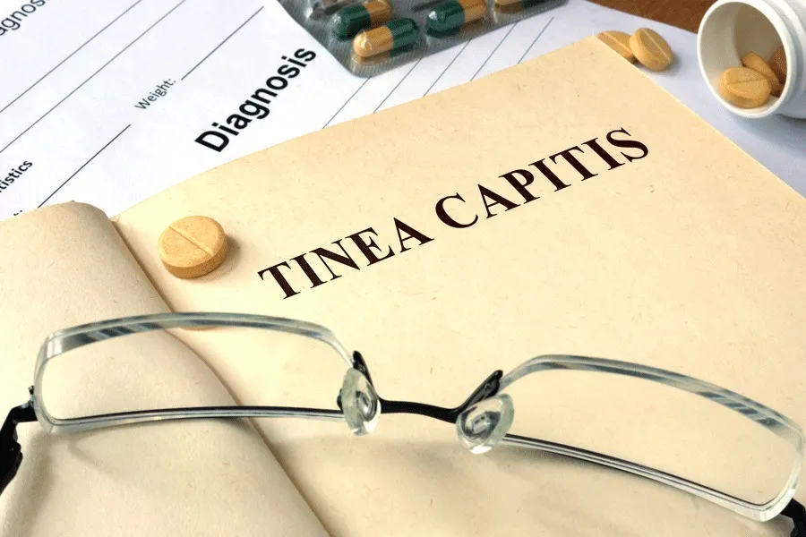 Tinea Capitis: Ringworm Haaruitval